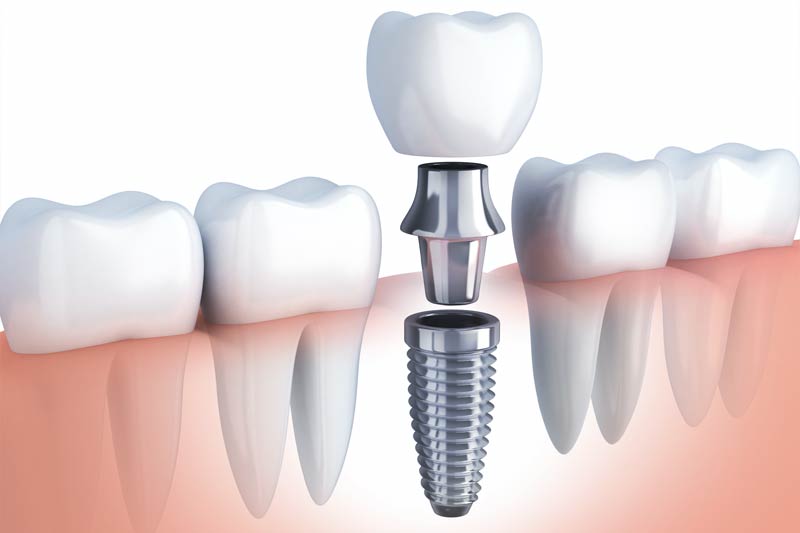 Implants Dentist in Rosharon